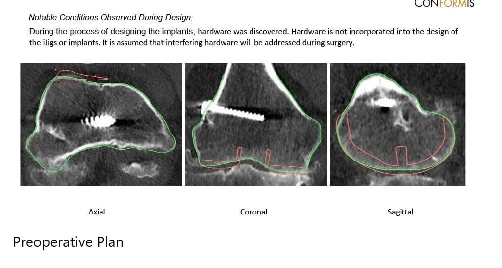Radiografía preoperatoria que muestra la vista AP y lateral de la rodilla derecha con tornillos retenidos, consistentes con la reconstrucción del LCA - img 3