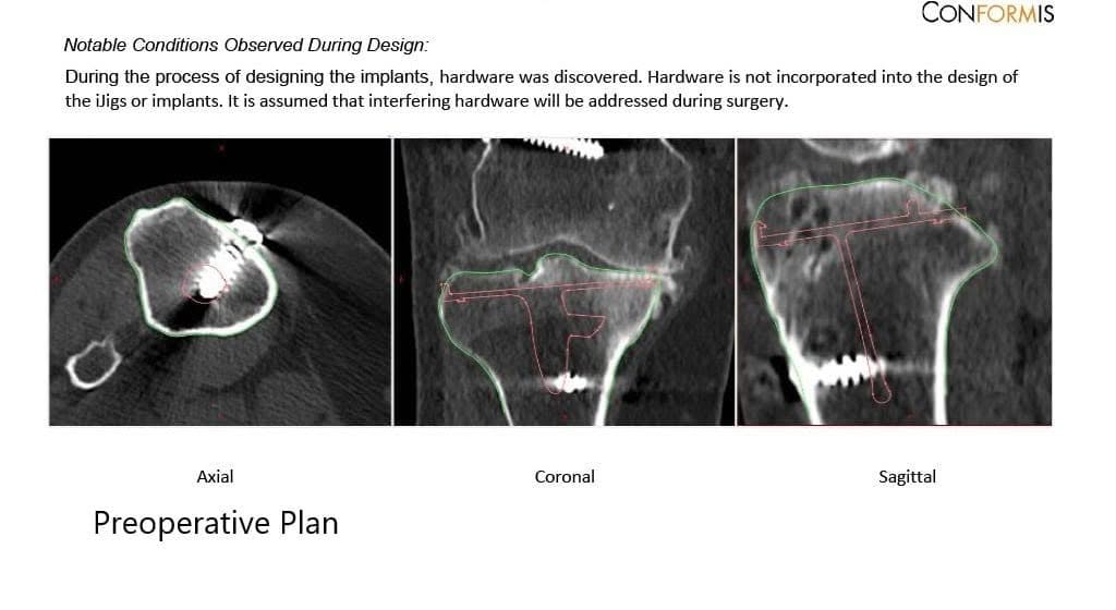 Radiografía preoperatoria que muestra la vista AP y lateral de la rodilla derecha con tornillos retenidos, consistentes con la reconstrucción del LCA - img 3