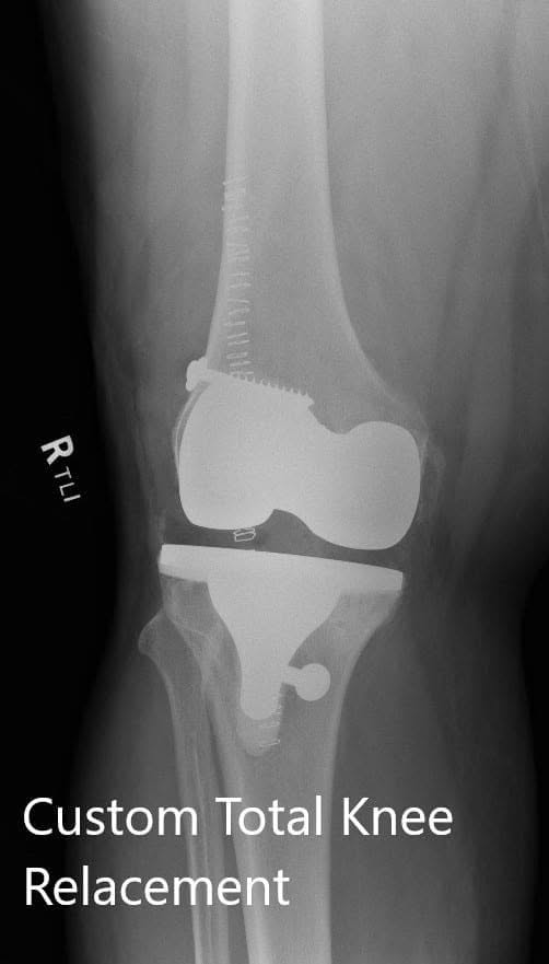 Postoperative images showing AP and lateral views of the right knee Postoperative images showing AP and lateral views of the right knee