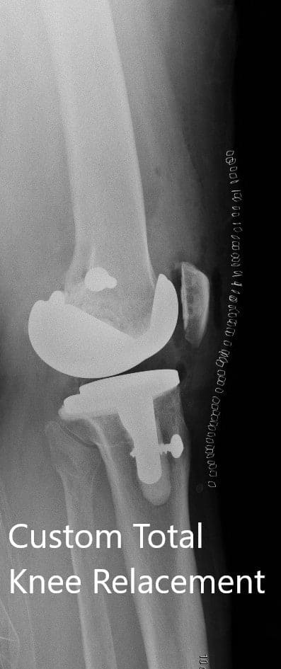 Postoperative images showing AP and lateral views of the right knee - img 2 Postoperative images showing AP and lateral views of the right knee - img 2