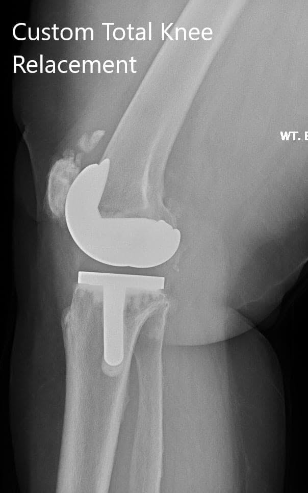 Postoperative X-ray showing the lateral views of both knees - img 2 Postoperative X-ray showing the lateral views of both knees - img 2