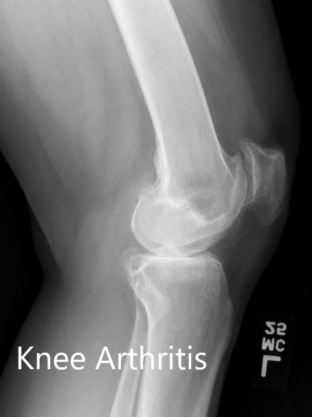 Preoperative X-ray of the left knee showing AP and lateral views - img 2 Preoperative X-ray of the left knee showing AP and lateral views - img 2