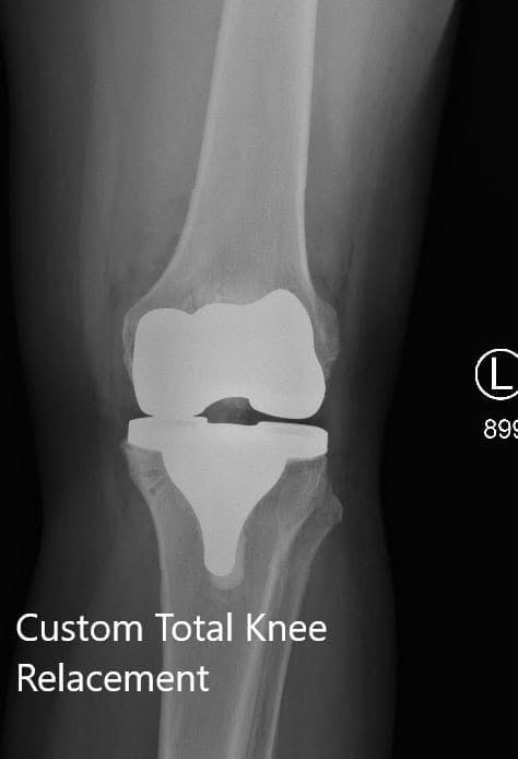 Postoperative X-ray showing the AP and lateral views of the left knee Postoperative X-ray showing the AP and lateral views of the left knee