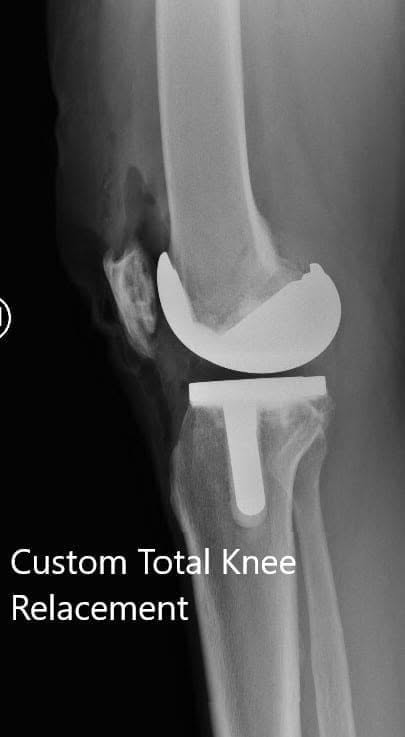 Postoperative X-ray showing the AP and lateral views of the left knee - img 2 Postoperative X-ray showing the AP and lateral views of the left knee - img 2