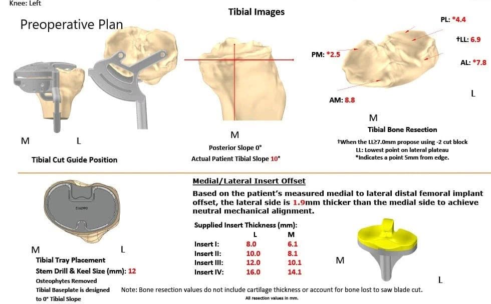 Complete Orthopedics patient specific surgical plan for a Customized Left Total Knee Replacement in a 73-year-old Male