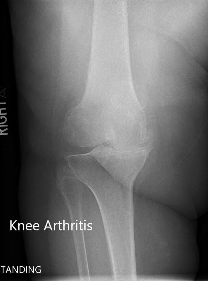 Radiografía preoperatoria de la rodilla derecha que mostró vistas AP y laterales
