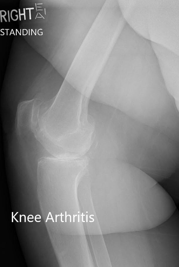 Radiografía preoperatoria de la rodilla derecha mostrando visión AP y lateral - IMG 2