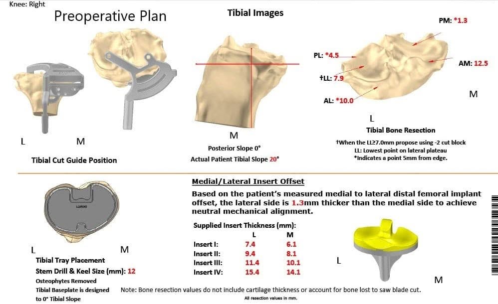Plan quirúrgico completo específico para pacientes de Ortopedia para un reemplazo personalizado de rodilla derecha en un paciente de 72 años