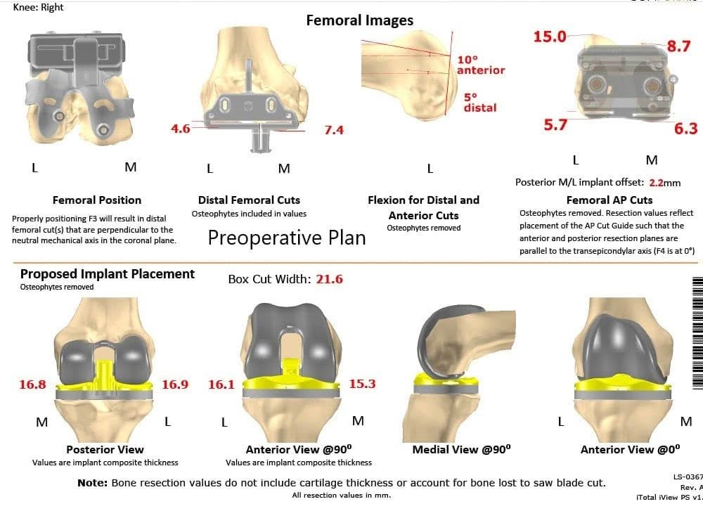 Plan quirúrgico completo específico para pacientes de Ortopedia para un reemplazo personalizado de rodilla derecha en un paciente de 72 años - escaneo 2
