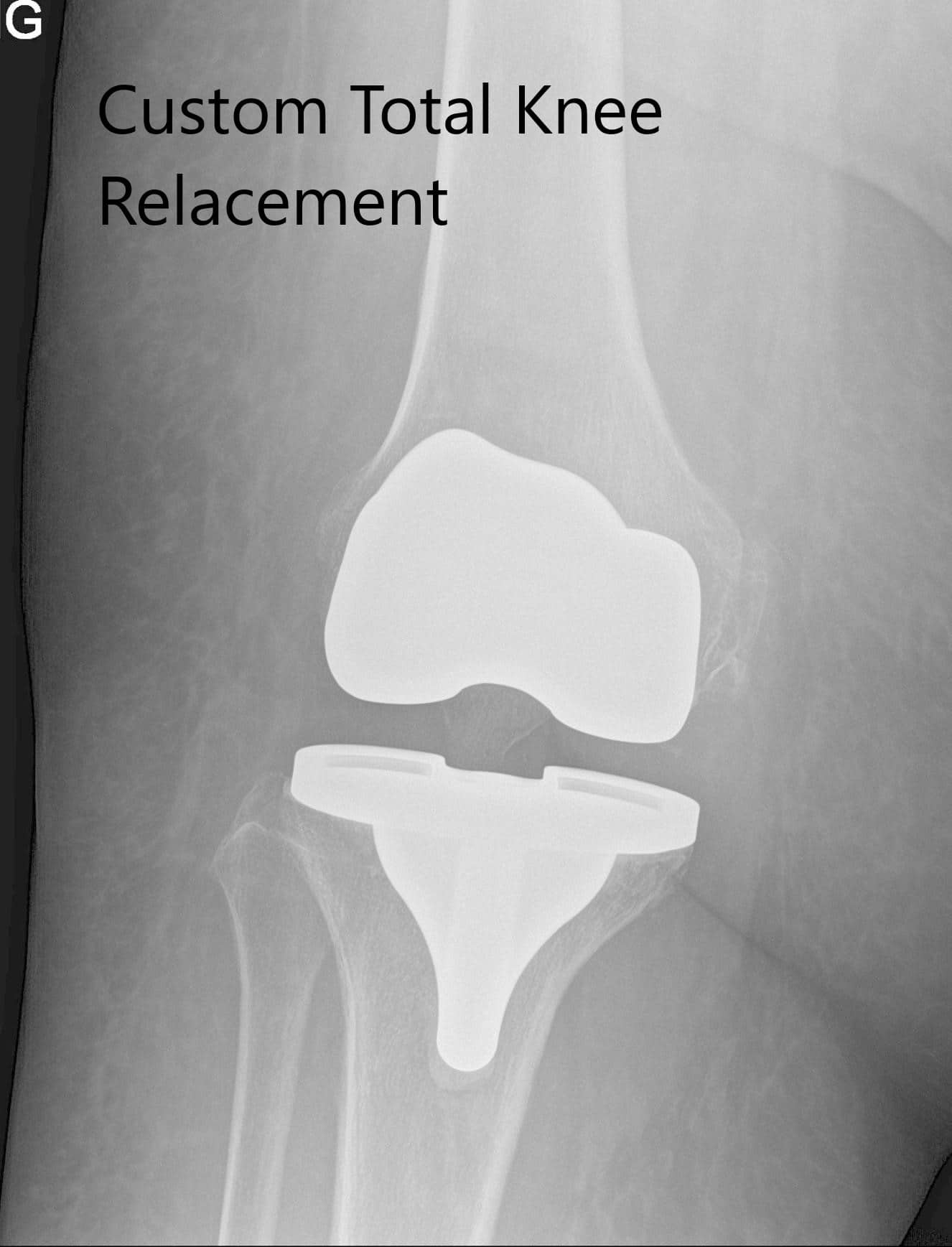 Imágenes de radiografía postoperatorias que muestran la AP y las vistas laterales de la rodilla derecha