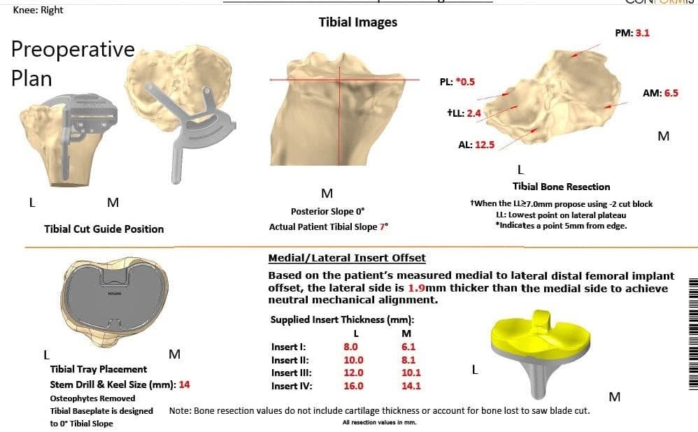 Plan quirúrgico completo específico para pacientes en Ortopedia para un reemplazo personalizado de rodilla derecha en una mujer de 65 años