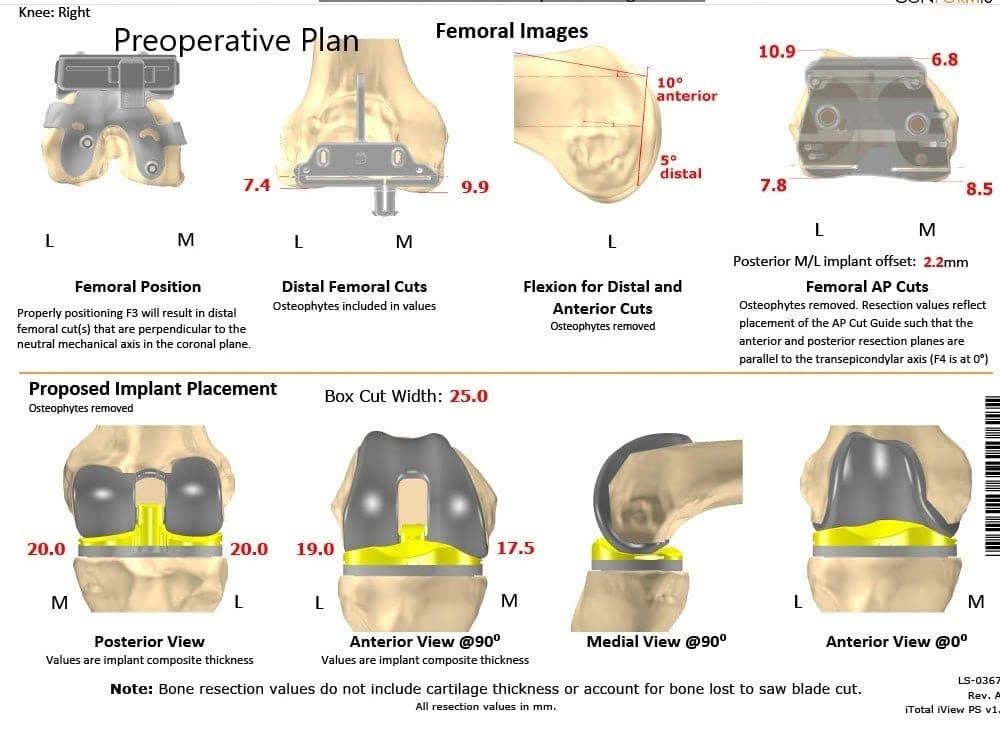 Complete Orthopedics patient specific surgical plan for a Customized Right Knee Replacement in a 65-year-old female - scan 2