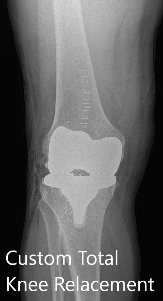 Radiografía postoperatoria que muestra la AP y las vistas laterales de la rodilla derecha Radiografía postoperatoria que muestra la AP y las vistas laterales de la rodilla derecha