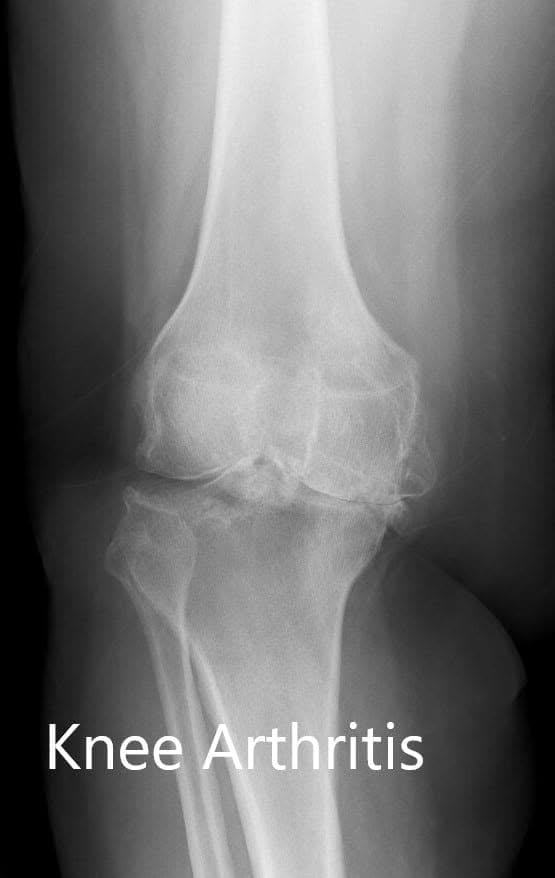 Preoperative X-ray of the right knee showing AP and lateral viewsPreoperative X-ray of the right knee showing AP and lateral views Preoperative X-ray of the right knee showing AP and lateral views
