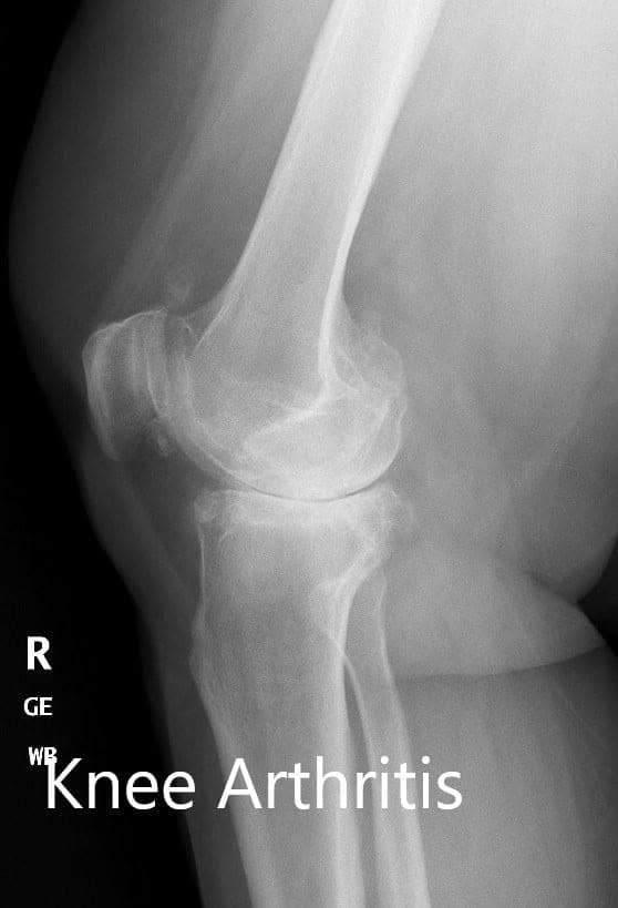 Preoperative X-ray of the right knee showing AP and lateral views - img 2 Preoperative X-ray of the right knee showing AP and lateral views - img 2