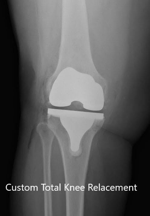 Postoperative X-ray of the right knee showing AP and lateral views Postoperative X-ray of the right knee showing AP and lateral views