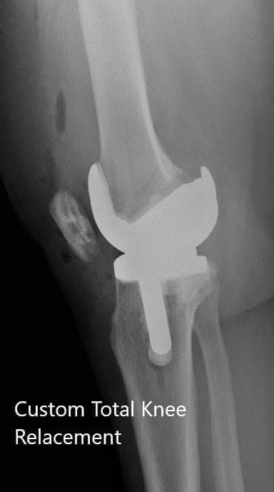Postoperative X-ray of the right knee showing AP and lateral views - img 2 Postoperative X-ray of the right knee showing AP and lateral views - img 2