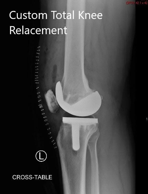 Radiografía postoperatoria de la rodilla izquierda que muestra vistas laterales y AP