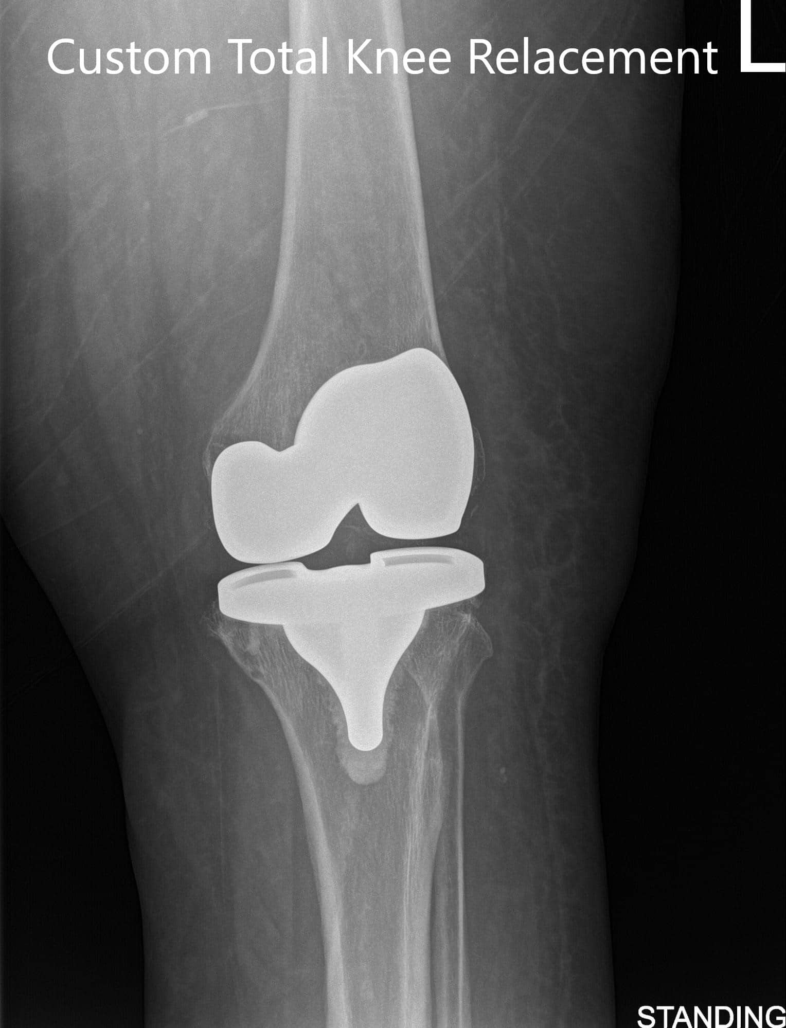 Radiografía postoperatoria que muestra imágenes AP e laterales de la rodilla izquierda Radiografía postoperatoria que muestra imágenes AP e laterales de la rodilla izquierda