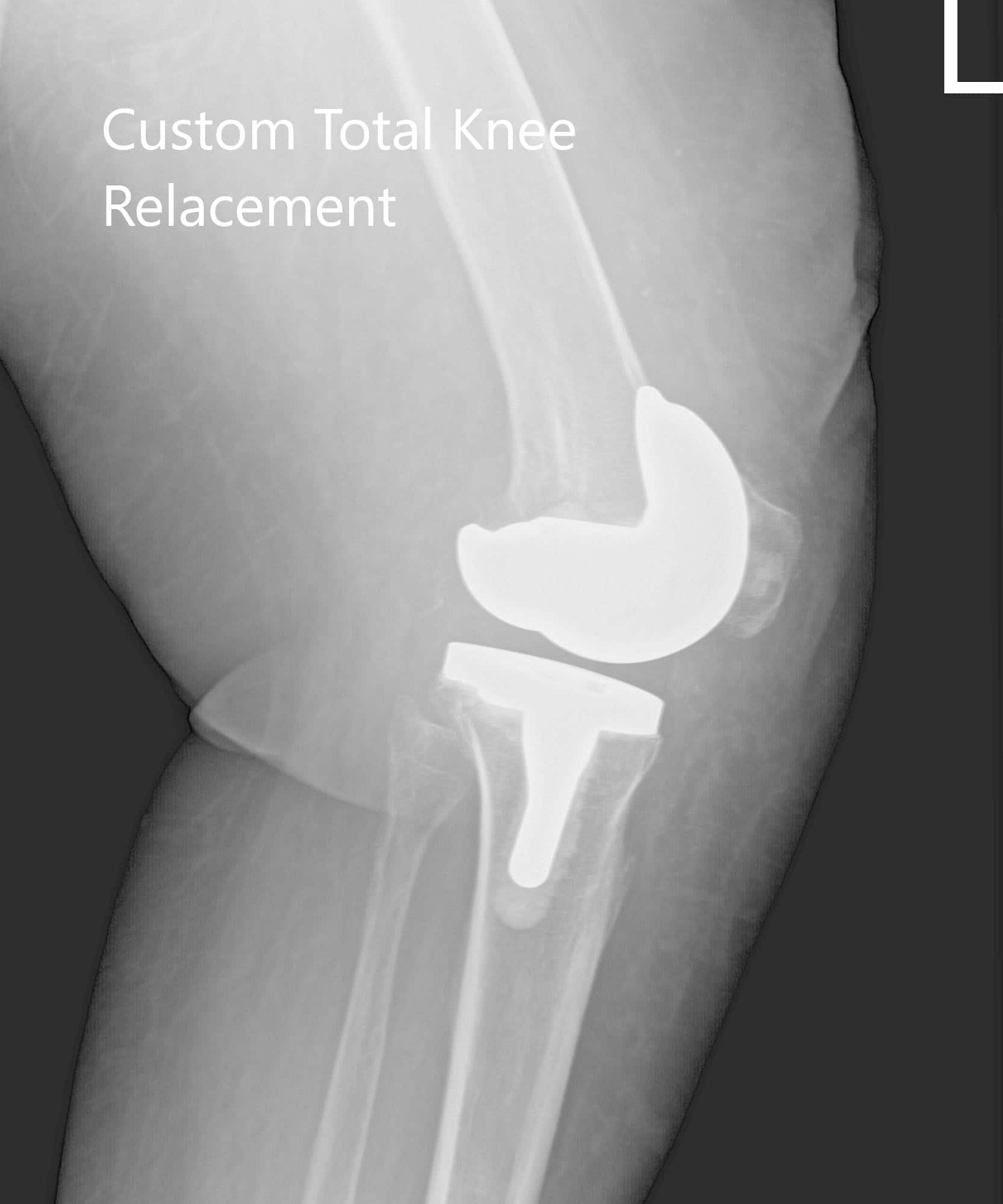 Radiografía postoperatoria que muestra imágenes AP e laterales de la rodilla izquierda - img 2 Radiografía postoperatoria que muestra imágenes AP e laterales de la rodilla izquierda - img 2
