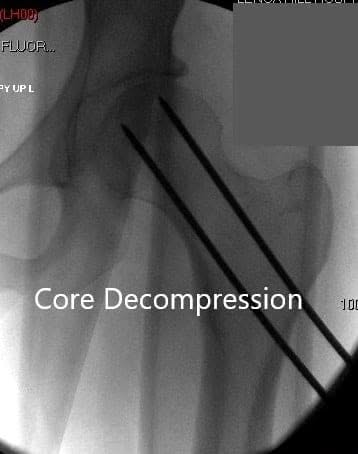Anteroposterior view of the left hip showing pre-collapse avascular necrosis of the left hip
