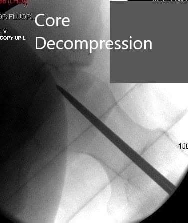 Anteroposterior view of the left hip showing pre-collapse avascular necrosis of the left hip - img 2