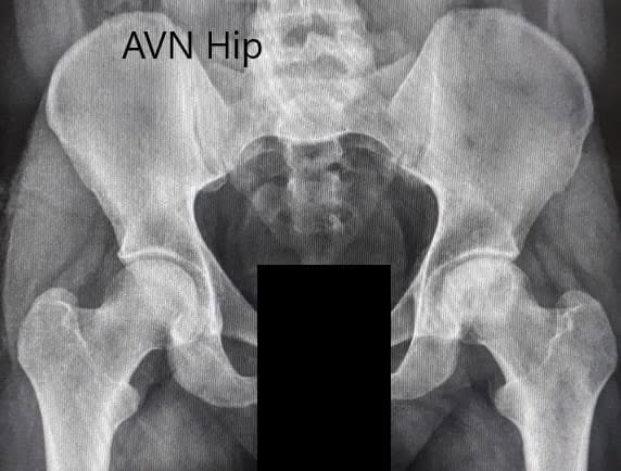 Radiografía preoperatoria de la pelvis con ambas caderas en vista anteroposterior que muestra el AVN de la cadera izquierda