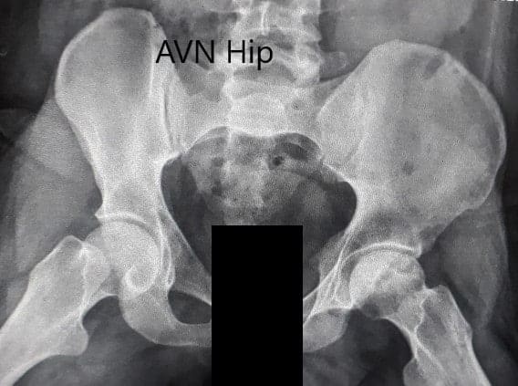 Radiografía preoperatoria de la pelvis con ambas caderas en la vista lateral con patas de rana que muestra el AVN de la cadera izquierda