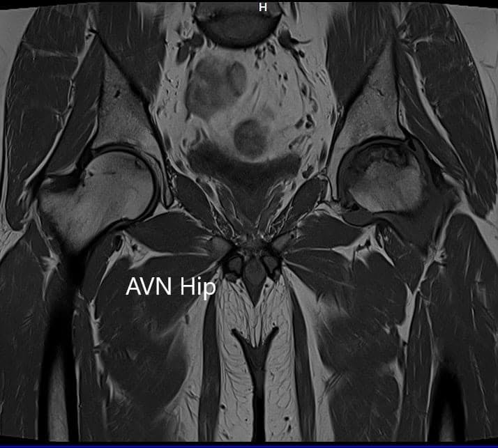 Sección coronal de la resonancia magnética T1WI que muestra la cadera AVN