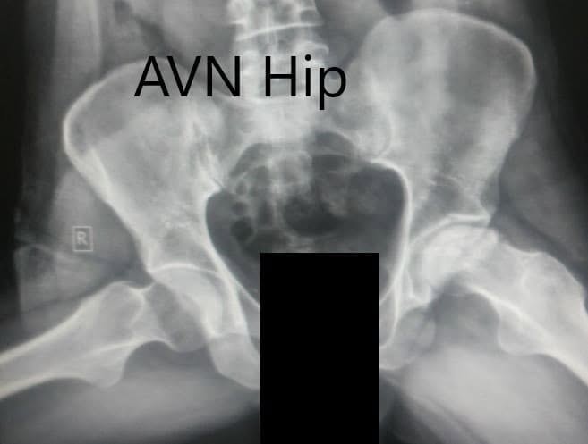 Frog-legged lateral view of both the hip joints Frog-legged lateral view of both the hip joints