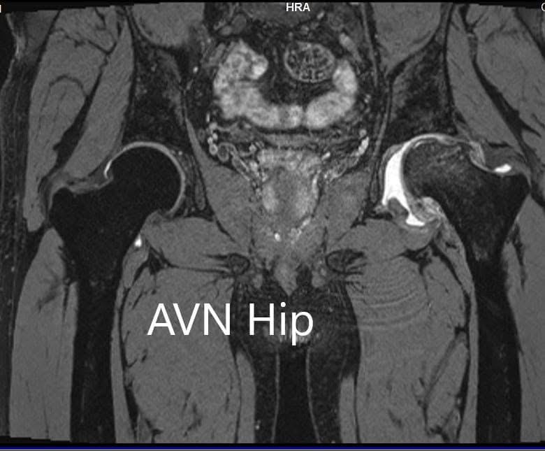 MRI images showing avascular necrosis of the left hip with collapse -scan 3