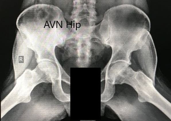 Preoperative X-ray of the pelvis with both hips in the frog-legged lateral view showing AVN of the bilateral hips Preoperative X-ray of the pelvis with both hips in the frog-legged lateral view showing AVN of the bilateral hips