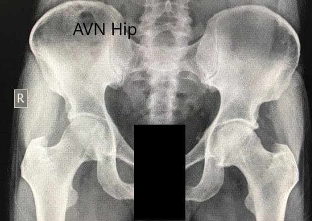 Preoperative X-ray of the pelvis with both hips in anteroposterior view showing AVN of the bilateral hips Preoperative X-ray of the pelvis with both hips in anteroposterior view showing AVN of the bilateral hips