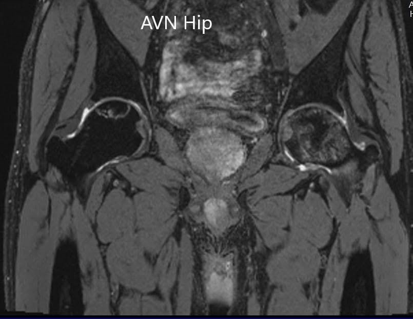 T2WI coronal section of MRI showing AVN hip T2WI coronal section of MRI showing AVN hip