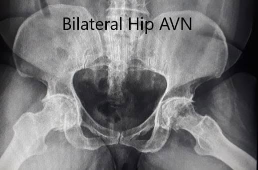Pre-operative X-ray of the pelvis in frog-legged lateral views