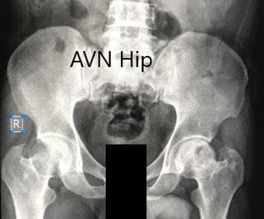 Preoperative X-ray of the pelvis with both hips in anteroposterior view showing AVN of the Left Hip Preoperative X-ray of the pelvis with both hips in anteroposterior view showing AVN of the Left Hip