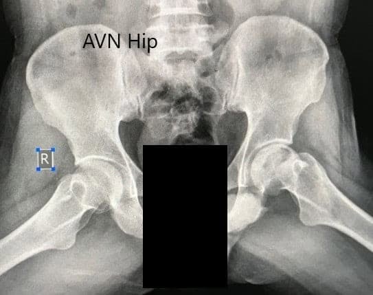 Preoperative X-ray of the pelvis with both hips in the frog-legged lateral view showing AVN of the Left Hip Preoperative X-ray of the pelvis with both hips in the frog-legged lateral view showing AVN of the Left Hip