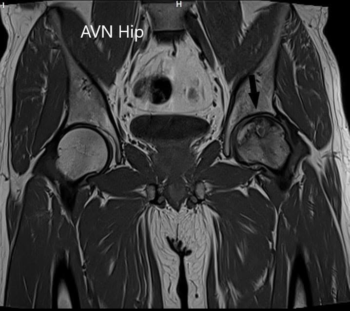 T1WI coronal section of MRI showing AVN hip T1WI coronal section of MRI showing AVN hip