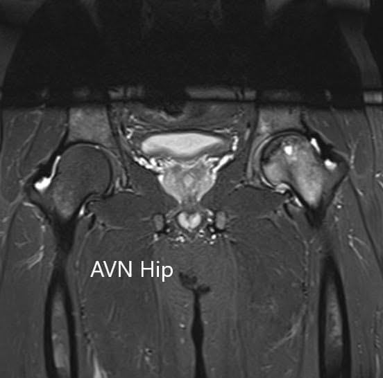 T2WI coronal section of MRI showing AVN hip T2WI coronal section of MRI showing AVN hip