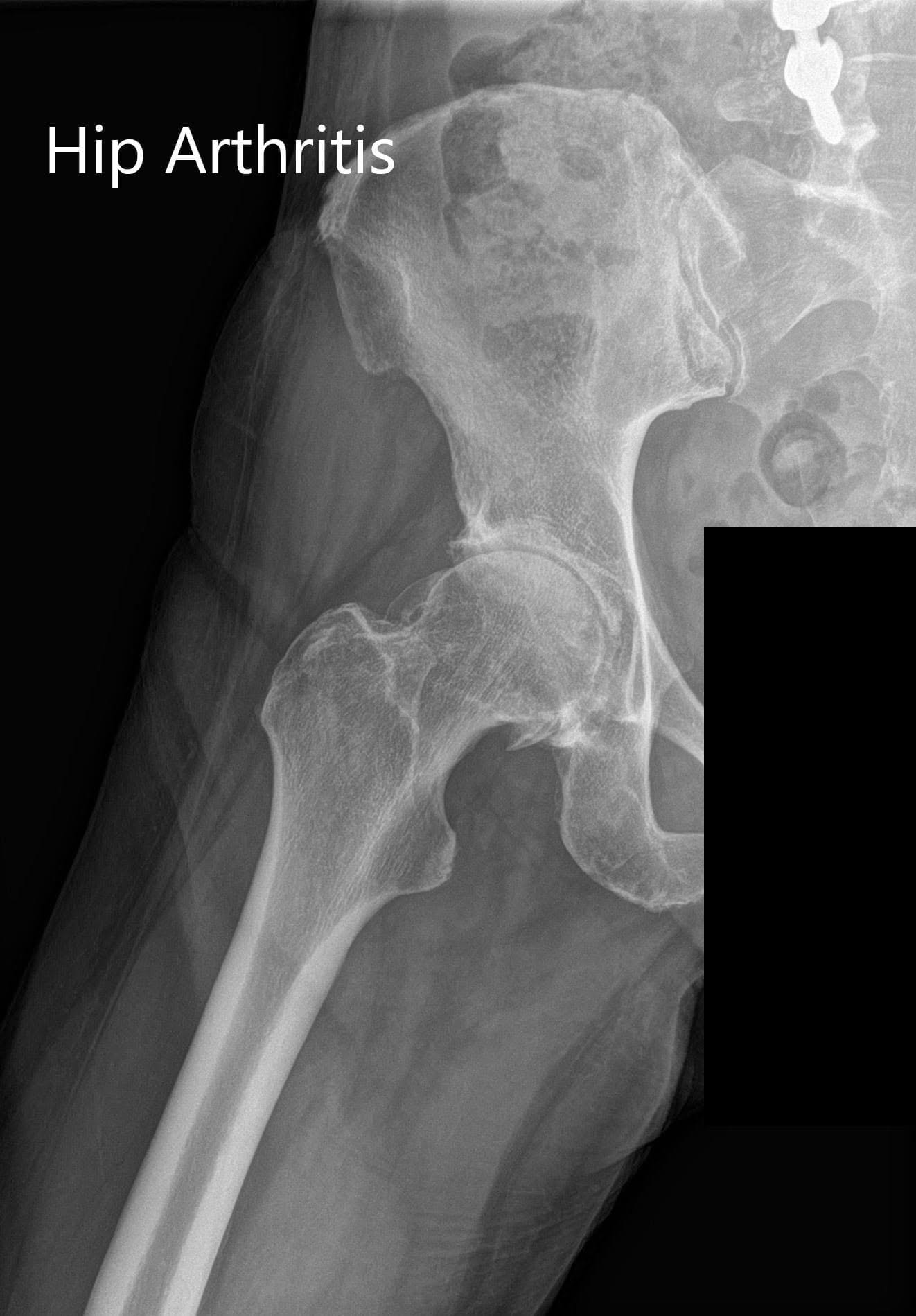 Radiografía preoperatoria que muestra las vistas AP y laterales de la cadera derecha - img 2