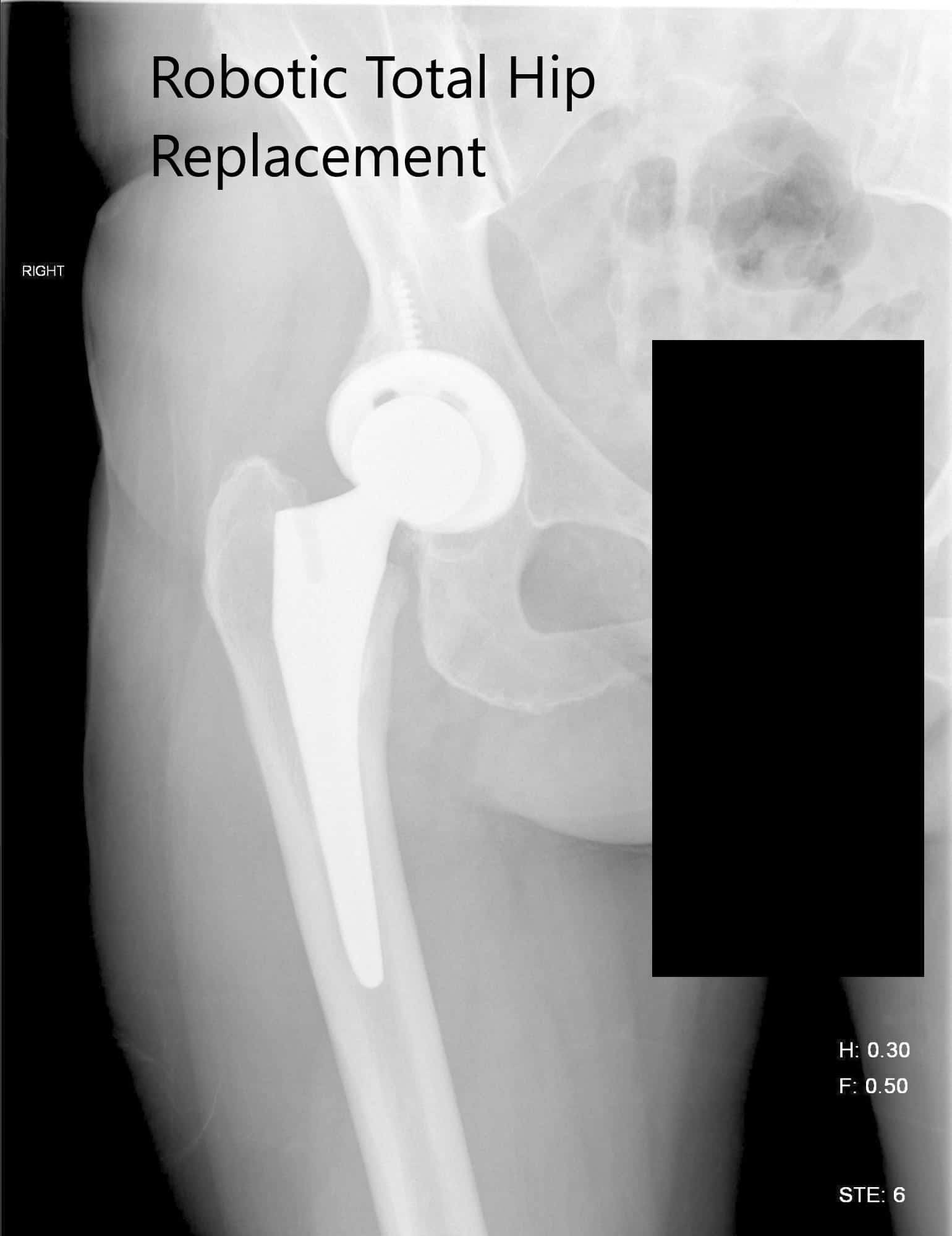 Radiografía postoperatoria de la cadera derecha que muestra visión penosariza y lateral