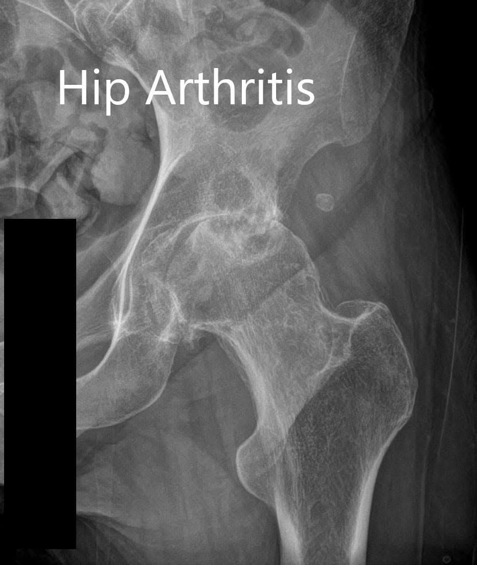 Preoperative X-ray of the left hip showing AP and lateral views