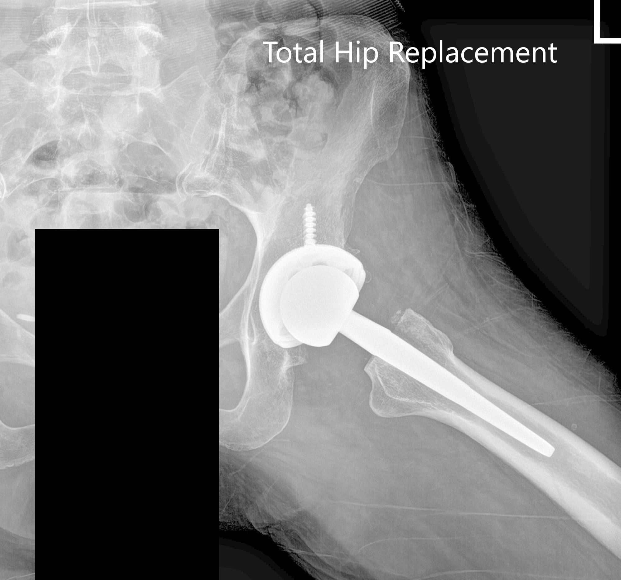 Radiografía postoperatoria de la cadera izquierda mostrando visión AP y lateral - img 2