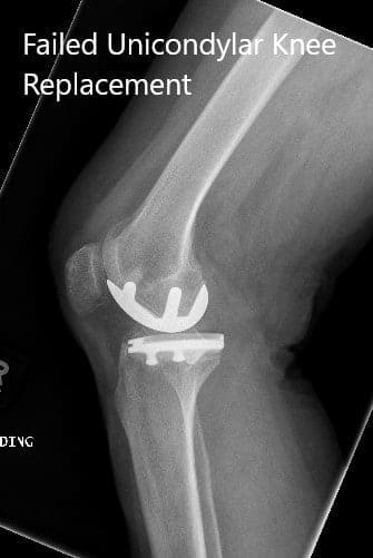 Radiografía preoperatoria de la rodilla derecha en vistas anteroposterior y lateral Radiografía preoperatoria de la rodilla derecha en vistas anteroposterior y lateral