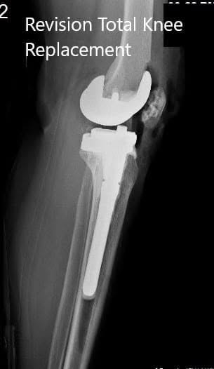 Radiografía postoperatoria que muestra las vistas lateral y anteroposterior de la rodilla derecha Radiografía postoperatoria que muestra las vistas lateral y anteroposterior de la rodilla derecha