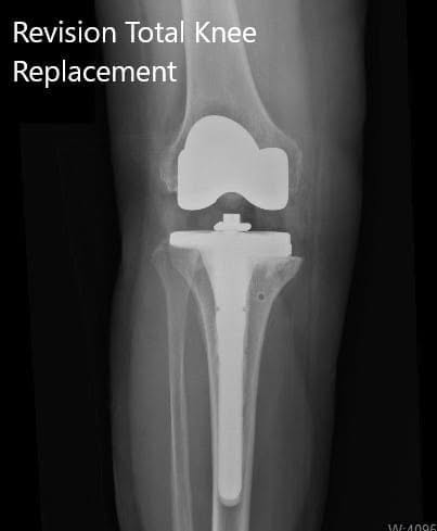 Radiografía postoperatoria que muestra las vistas lateral y anteroposterior de la rodilla derecha - img 2 Radiografía postoperatoria que muestra las vistas lateral y anteroposterior de la rodilla derecha - img 2