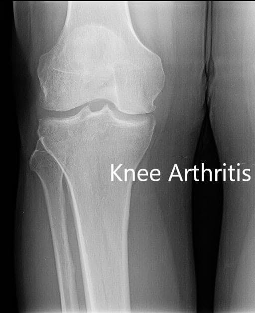 Preoperative X-ray showing AP and lateral view of the right knee joint, and skyline view of both the knee joints Preoperative X-ray showing AP and lateral view of the right knee joint, and skyline view of both the knee joints