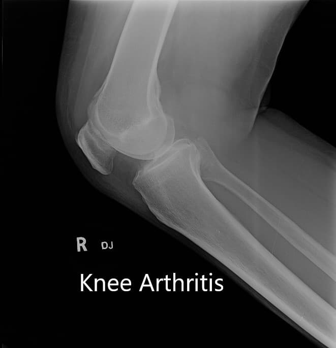 Preoperative X-ray showing AP and lateral view of the right knee joint, and skyline view of both the knee joints - img 2 Preoperative X-ray showing AP and lateral view of the right knee joint, and skyline view of both the knee joints - img 2