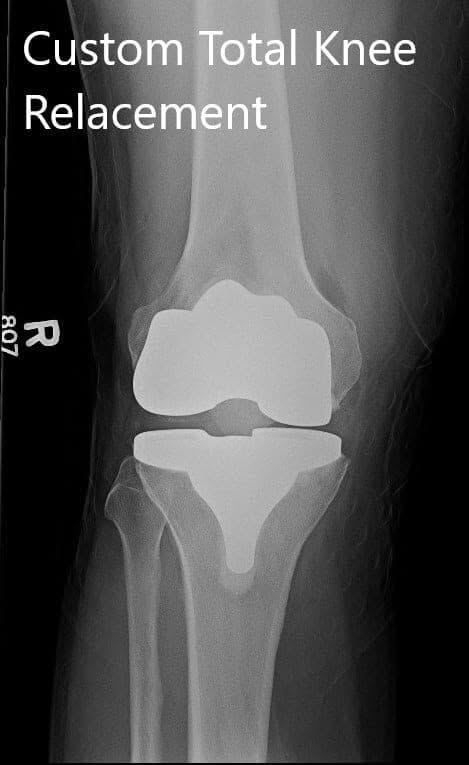 Postoperative X-ray showing AP and lateral images of the right knee Postoperative X-ray showing AP and lateral images of the right knee