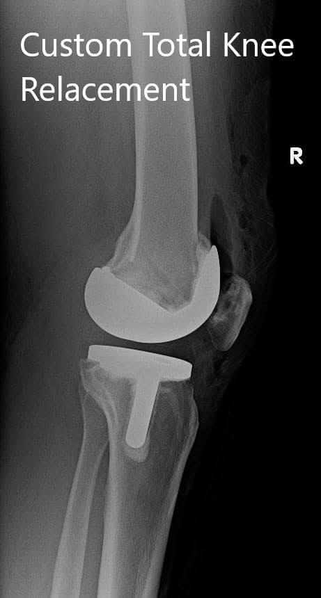 Postoperative X-ray showing AP and lateral images of the right knee - img 2 Postoperative X-ray showing AP and lateral images of the right knee - img 2